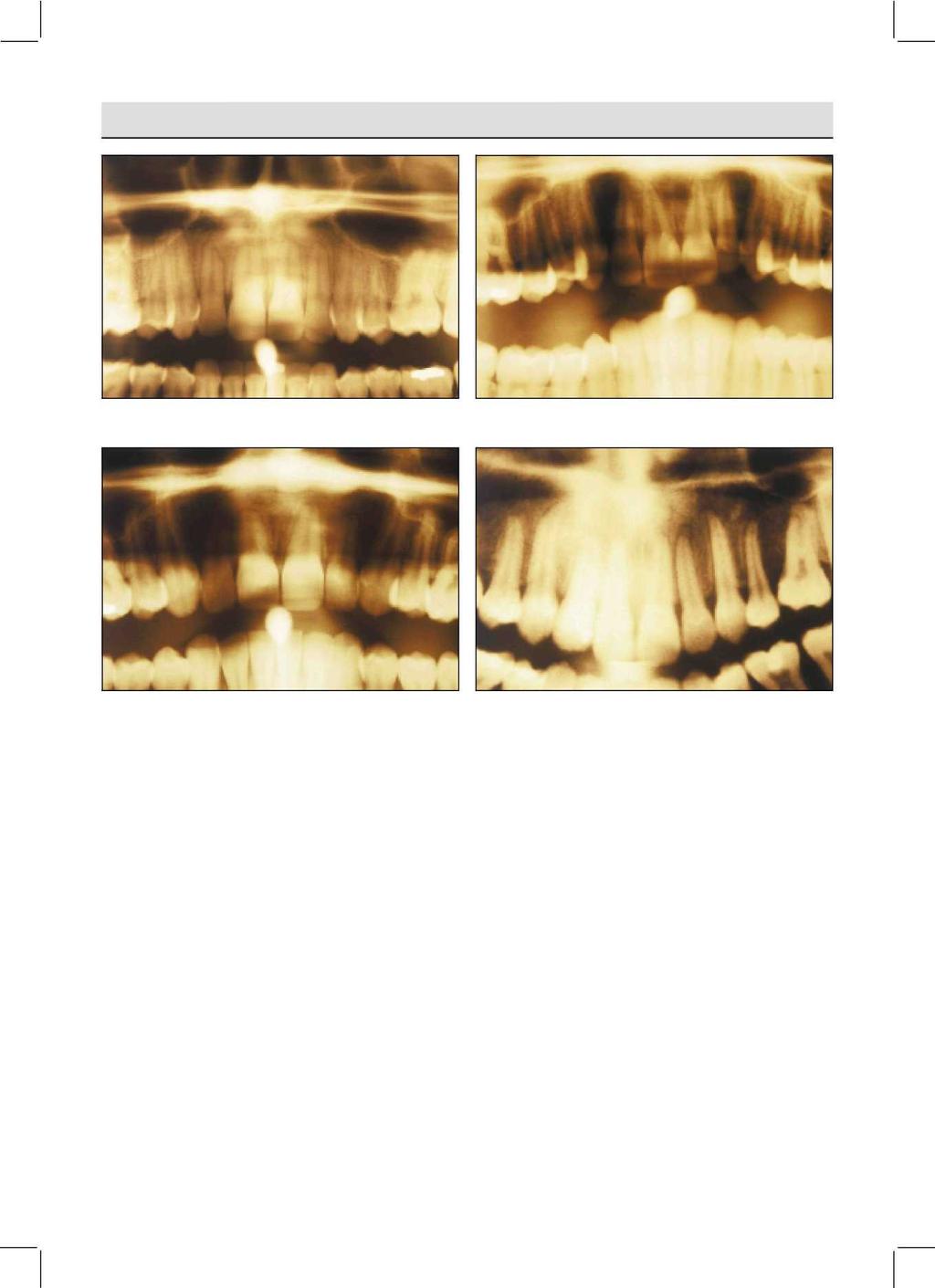 ORTODONCIE Odborná práce ročník 11 č. 2.2001 Obr. 7. Apexy řezáků s různými typy resorpčního zakončení. Fig. 7. Incisors with different types of resorption. Obr. 8.