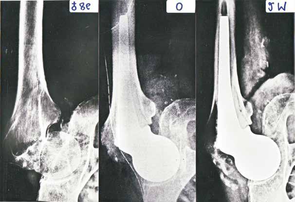 Popis implantátu Operační postup Instrumentárium Katalogová nabídka Úvod Cervikokapitální endoprotéza kyčelního kloubu vyráběná firmou Beznoska byla vyvinuta před více jak 30 léty.