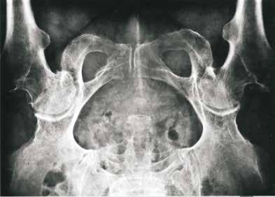 Popis implantátu Operační postup Instrumentárium Katalogová nabídka Operační technika cementované monoblokové