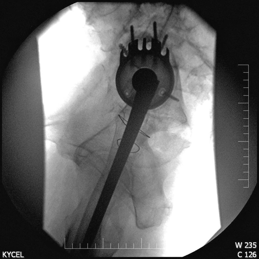 (tab. 1). Podle rtg došlo jedenkrát k proximálnímu posunu jamky při defektním acetabulu typu 3B dle Paproskyho s prokazatelnou osteolýzou v okolí implantátu i všech šroubů.