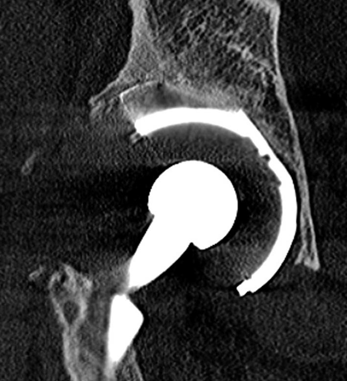 Dle Götze by měl povrch implantátu bez použití kostního cementu dosahovat kontaktu s původním kostním lůžkem Graf 1 alespoň z 50 %