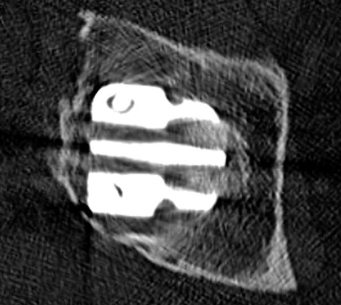 Standardní necementované implantáty s osteoaktivním povrchem lze zvolit při zachování předního a zadního pilíře acetabula (IIA a