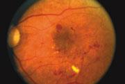 V případě mírné či středně závažné diabetické retinopatie je důležitá spolupráce s diabetologem, protože správná kontrola hladiny cukru v krvi může zpomalit postup onemocnění.