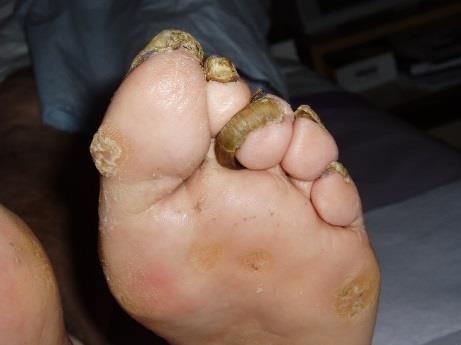3. Diagnostika a prevence diabetické nohy 3.1 Diagnostika syndromu diabetické nohy V diagnostice SDN je nutné se zaměřit na přítomnost neuropatie a angiopatie.