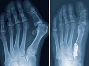 Radiologické zobrazovací metody A. Nativní rentgenový snímek nohy Nativní rentgenový snímek (obr. 31) by měl být prvním zobrazovacím testem. Je levný a dostupný.