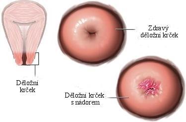 Příloha č. 3 Zdravý děložní krček vs.