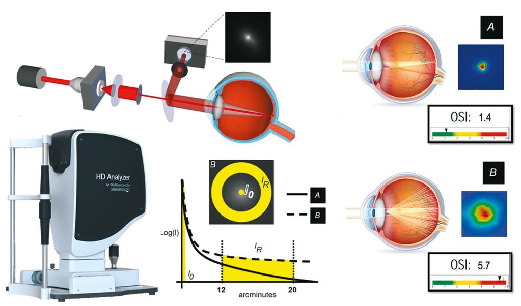 4: Přístroj HD Analyzer od firmy Visiometrics (upraveno z [8,11]) intraokulárního rozptylu neexistuje prakticky žádná rele- Z hlediska klinické praxe je tedy velmi důležité umět kvality vidění ve