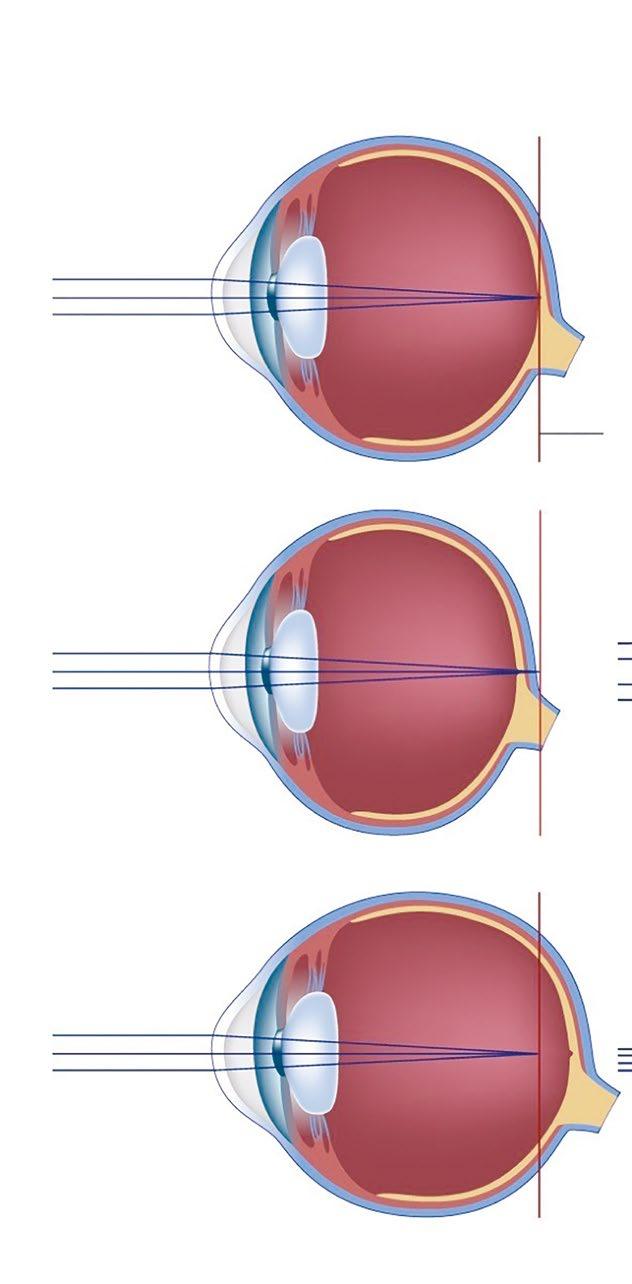 Klíčovým příkladem jsou zrakové následky po těžkých formách ROP (retinopatie nedonošených), ale i úspěšně léčené děti pro ROP mohou být i za velmi pozdní dobu postiženy glaukomem nebo odchlípením