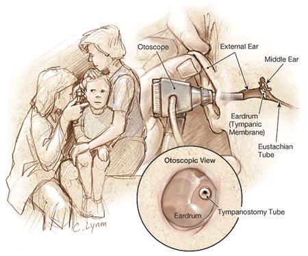 Otitis media http://www.medem.