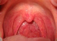 Virová (vlevo) a bakteriální tonsilopharyngitis http://upload.wikimedia.