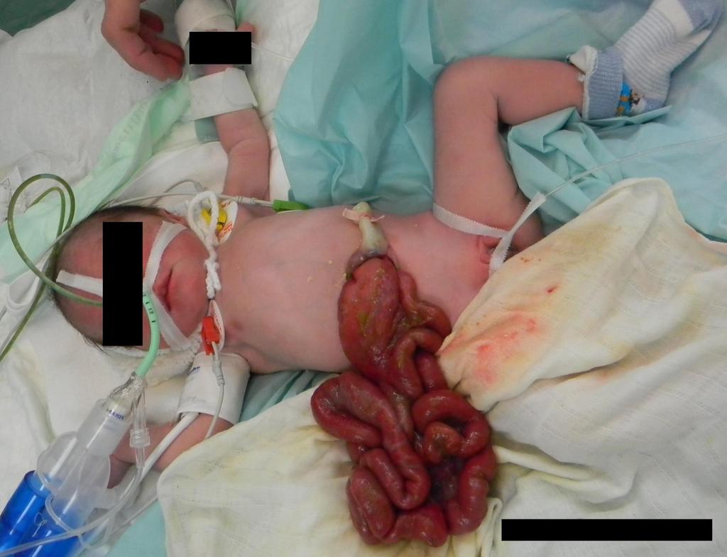 Invaginace Volvulus Cévní trombotizace Cévní trombózy/ embolie Gastroschíza