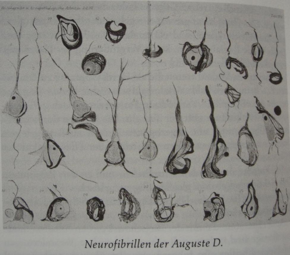 Alzheimer A. Über eine eigenartige Erkrankung der Hirnrinde.