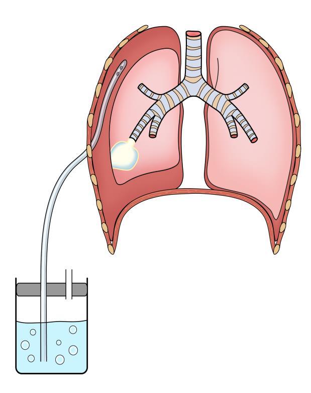 Příloha k informovanému souhlasu s plánovaným výkonem: Léčba pneumotoraxu, fluidotoraxu, a hrudní drenáž účel, povaha, předpokládaný prospěch, následky a možná rizika plánovaného zdravotního výkonu: