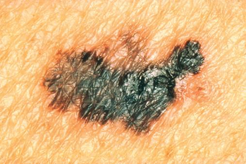 Barva: Melanomy obvykle nemají pouze jednu barvu a mohou být hnědé až černé s červeným, růžovým,