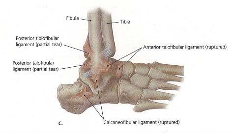 Příloha 11a. STUPNĚ PORANĚNÍ HLEZENNÍHO KLOUBU (Wolfe, W a et al., 2001) 3.