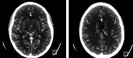 Obrázek č. 3: Normální CTA s plněním v.cerebri interna bilat.