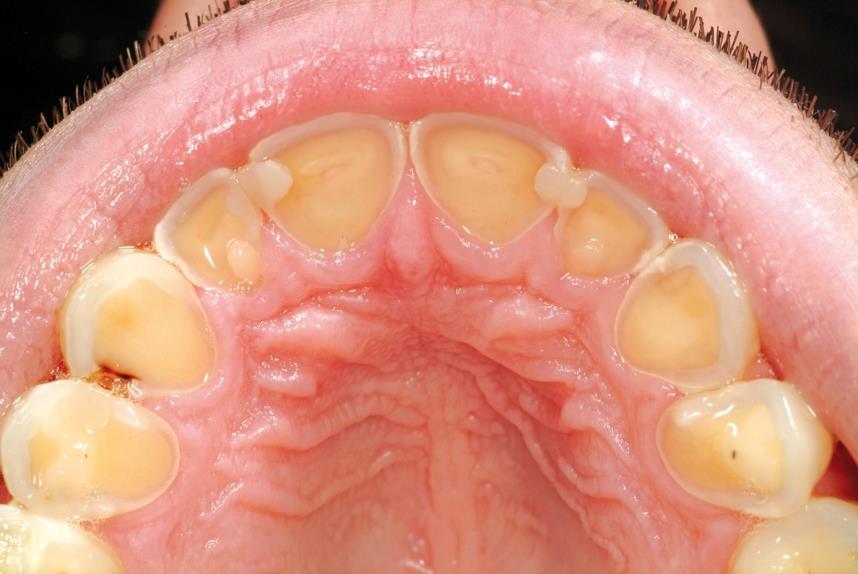 Obrázek 1 Abraze frontálních zubu 3.4.1 První fáze V první fázi je v laboratoři zhotoven estetický wax-up frontálních zubů jíž se zvýšenou okluzí.