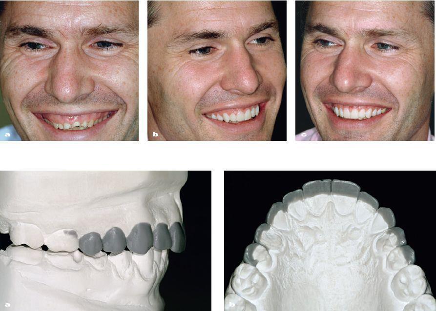 Obrázek 2 Zhotovení wax-upu a následně mock-upu 3.4.2 Druhá fáze Ve druhé fázi se nahrazují okluzní plochy distálních zubů.