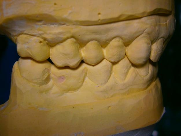 2 Druhá laboratorní fáze V ordinaci byla provedena analýza stávající situace zubních oblouků na modelech.