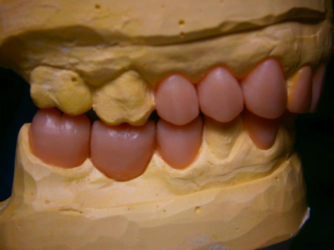 nové řezákové vedení s estetickým tvarem frontálních zubů.