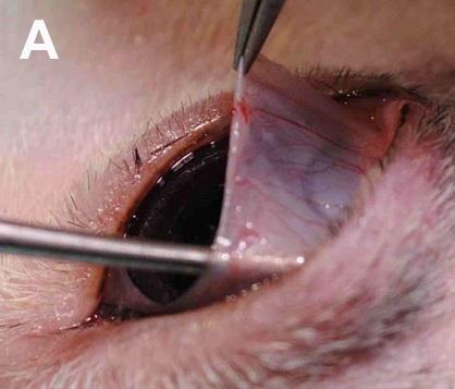 Odstranění pseudopterygia a plastika víček Revize