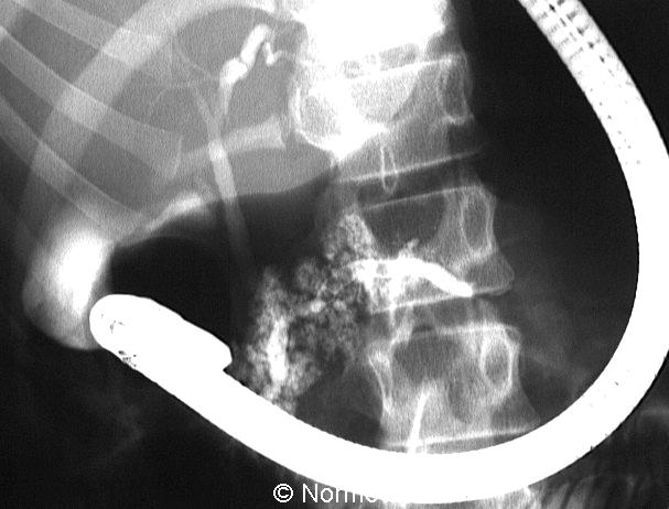 CHRONICKÁ PANKREATITIDA ZOBRAZOVACÍ METODY ERCP