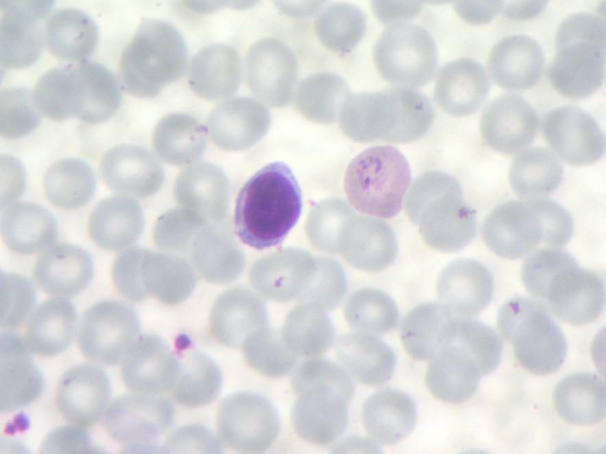 P. vivax (třídenní malárie, terciána) Plasmodium vivax napadá přednostně retikulocyty,