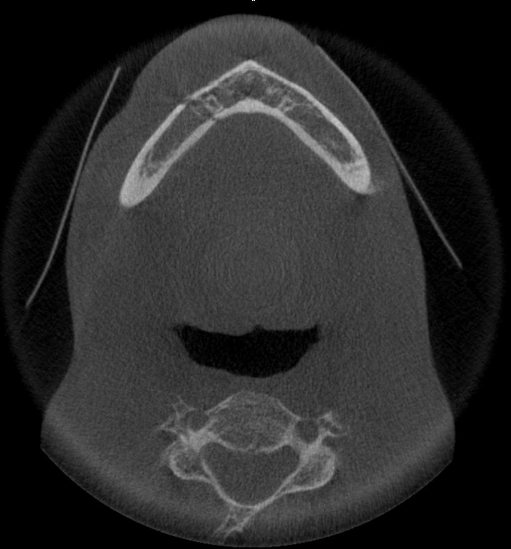 Obrázek 17 CBCT snímek fraktury v dolní