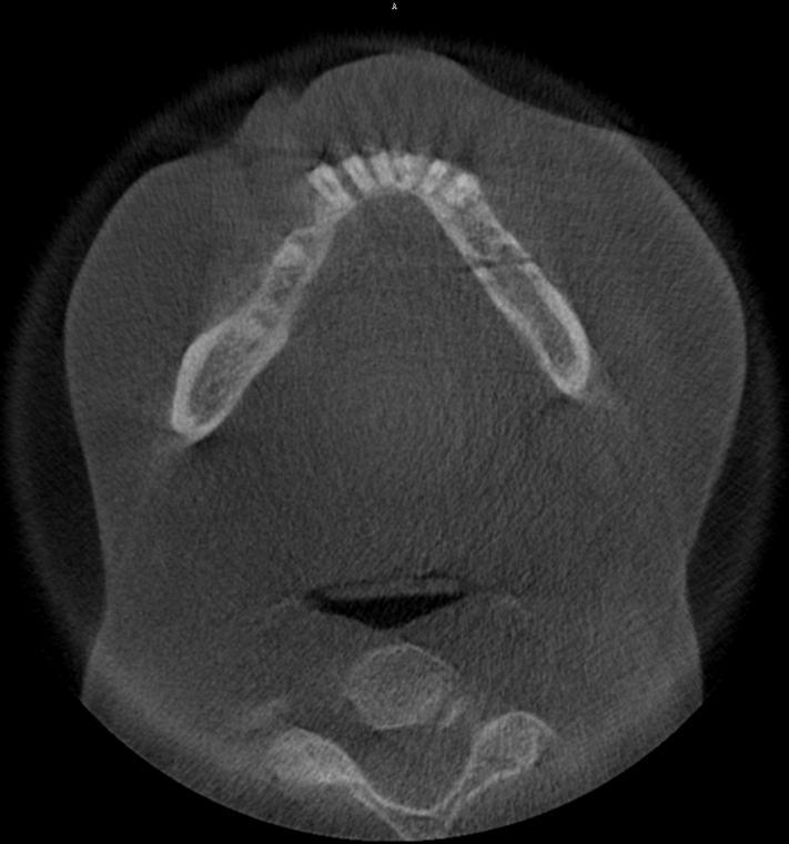 Obrázek 22 CBCT snímek s frakturou v dolní