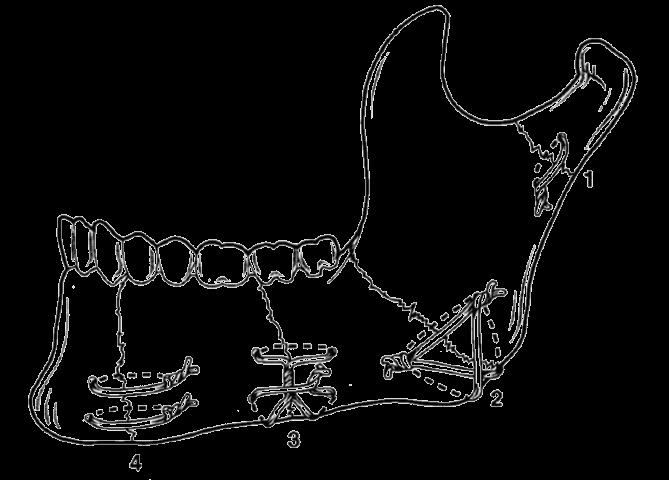 6.2.2 Chirurgické ošetření Podstatou chirurgického (otevřeného) způsobu ošetření je důkladná anatomická repozice kostních úlomků a jejich následné spojování pod kontrolou zrakem.