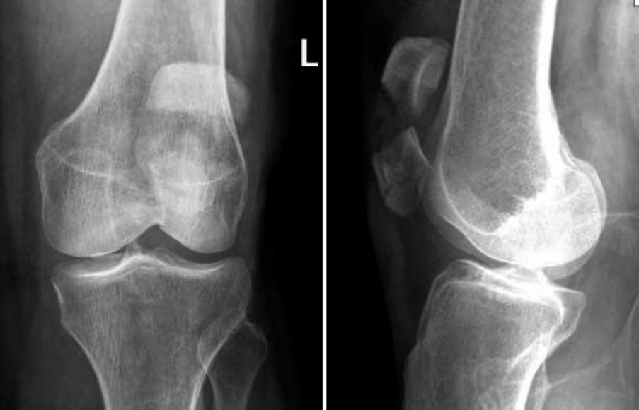 204/ Acta Chir Orthop Traumatol Cech. 84, 2017, No. 3 PŮVODNÍ PRÁCE VÝSLEDKY Zhojilo se celkem 27 zlomenin (93,1 %) v průměrném časovém odstupu od primární operace 10,3 týdne (rozmezí 4,3 30).
