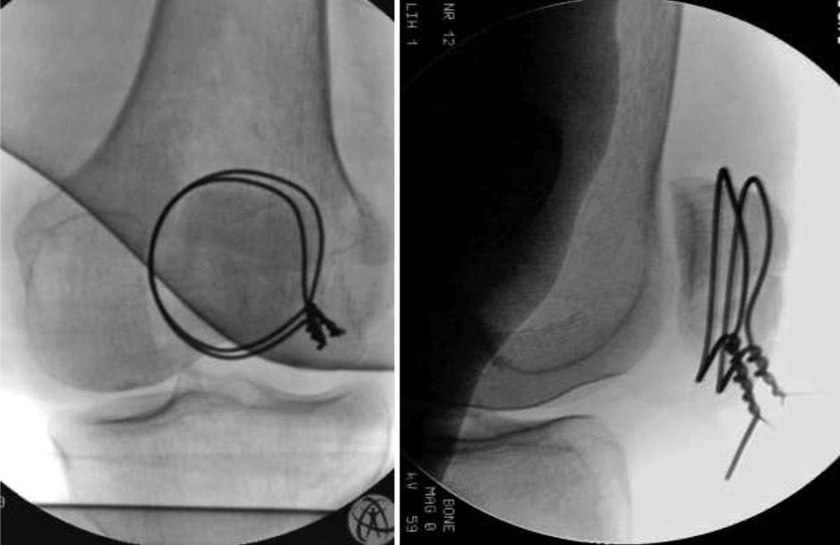 Ve čtyřech případech byly při osteosyntéze etážovou cerkláží ještě použity Kirschnerovy dráty k fixaci malých nitrokloubních fragmentů.
