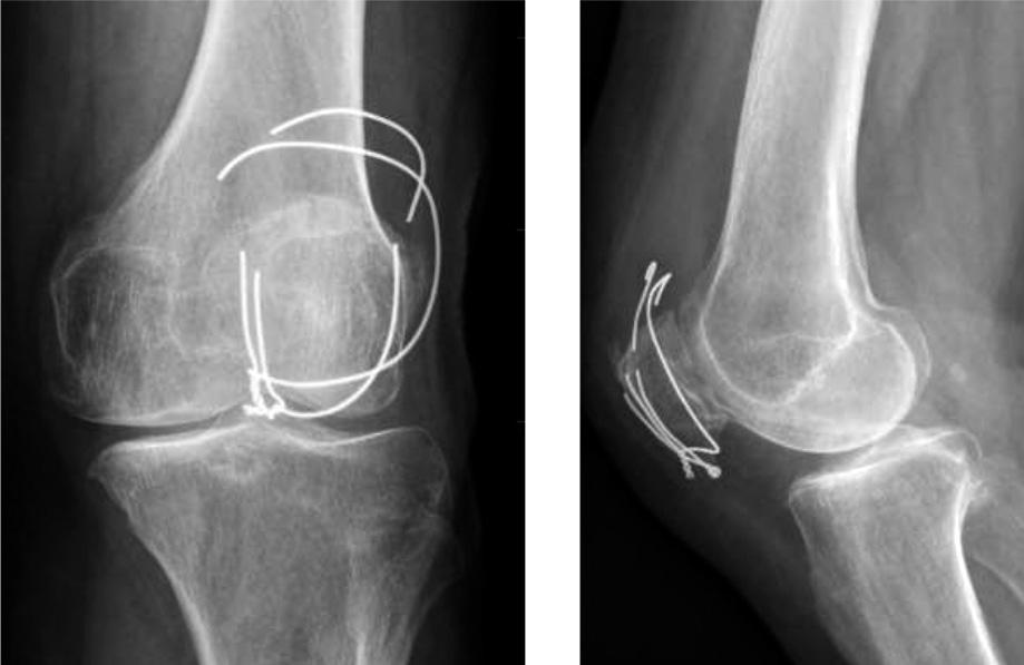205/ Acta Chir Orthop Traumatol Cech. 84, 20