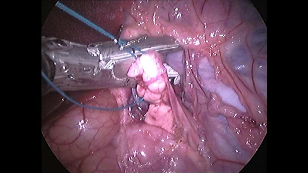 kapnoperitoneum, které bylo udržováno na 12 mm Hg během celé operace.