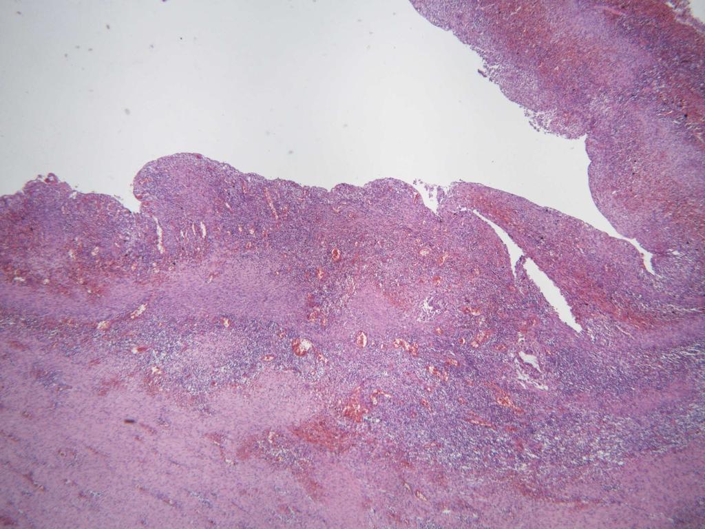 Obrázek 12 Mikroskopické hodnocení abscesu v místě resekční linie pankreatu (experimentální zvíře č.