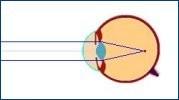 Při operaci se laserovým paprskem postupně odpařuje povrch rohovky, až se získá její požadovaný tvar.