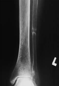 KAZUISTIKA dou malabsorpčního syndromu s průjmy (steatorhea), únavou a váhovým úbytkem, doprovázené karencí živin, minerálů a vitamínů, obvykle nejsou diagnostickým problémem.