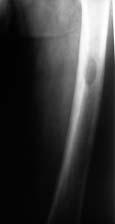 KAZUISTIKA Obrázek 7 RTG femuru: loïisko osteol zy velikosti 4 x 2 cm v horní diaf ze levého femuru Obr. 8 RTG levého femuru, boãní projekce: Osteolytické loïisko v horní diaf ze femuru Obr.