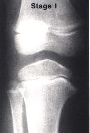 Tibia