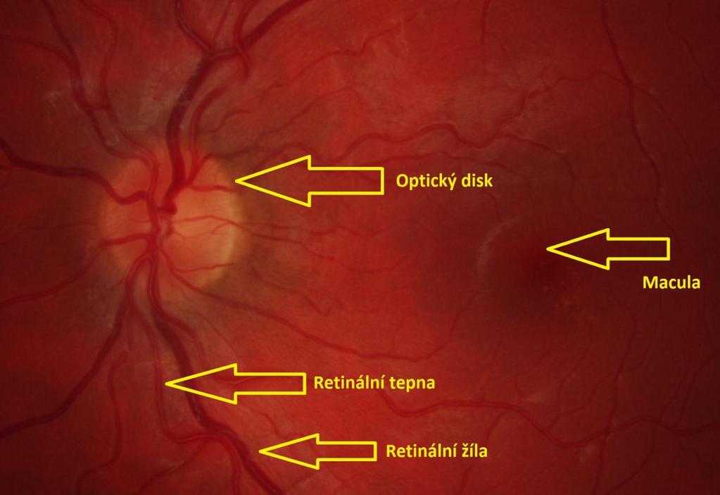 místem nejostřejšího vidění. Zbarvení pozadí snímku je způsobeno prosvítáním cévnatky skrz retinální pigmentový epitel. Toto zbarvení bývá spojeno s barvou pleti jedince. Obr. 2.