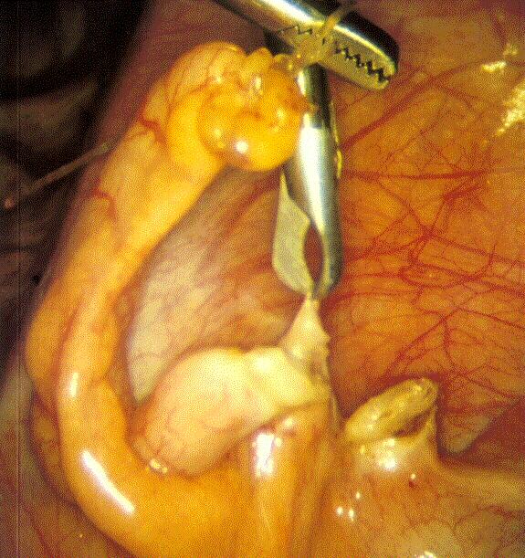 endometriózy
