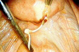 - IUD