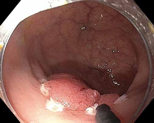 Endoskopická transmurální resekce v léčbě lokálních reziduálních neoplazií Hereditárny tlustého angioedém střeva analýza ako príčina souboru bolestí 19 pa brucha cientů Úvod Lokální reziduální