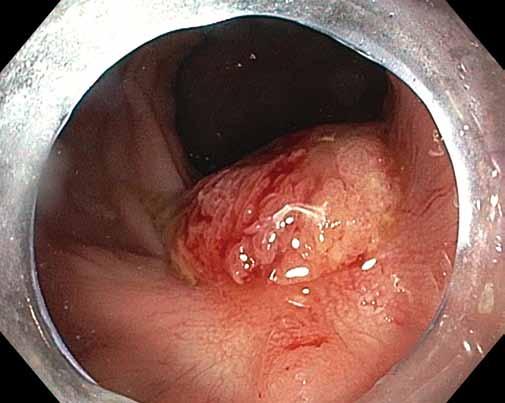 Hereditárny Endoskopická angioedém transmurální ako resekce príčina bolestí v léčbě brucha lokálních reziduálních neoplazií tlustého střeva analýza souboru 19 pa cientů Obr. 2.