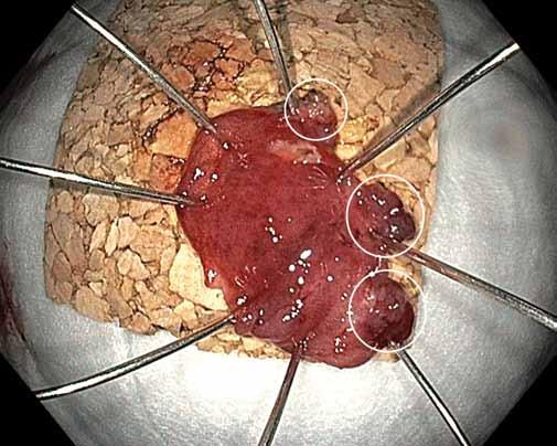 Endoskopická transmurální resekce v léčbě lokálních reziduálních neoplazií Hereditárny tlustého angioedém střeva analýza ako príčina souboru bolestí 19 pa brucha cientů Obr. 3.