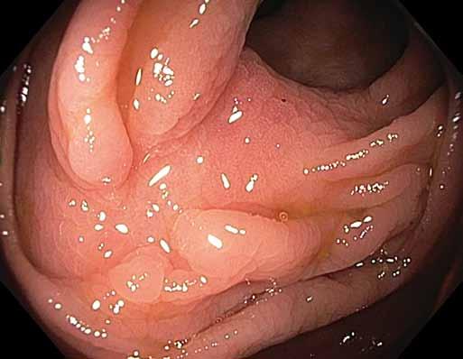 Hereditárny Endoskopická angioedém transmurální ako resekce príčina bolestí v léčbě brucha lokálních reziduálních neoplazií tlustého střeva analýza souboru 19 pa cientů Obr. 5.