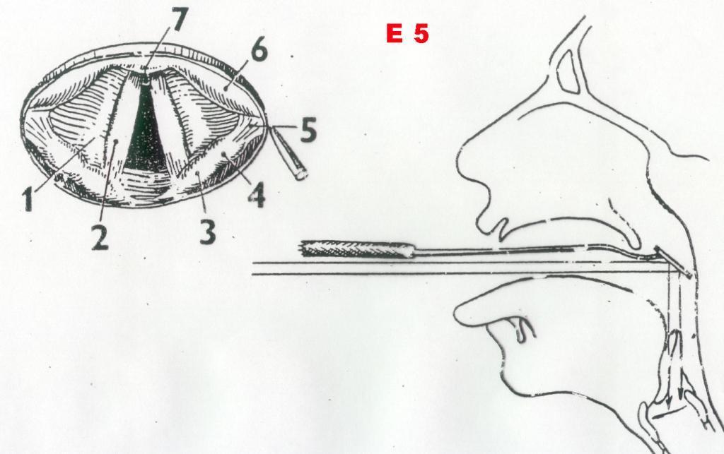 Laryngoskopie plicae vocales (hlasivky)