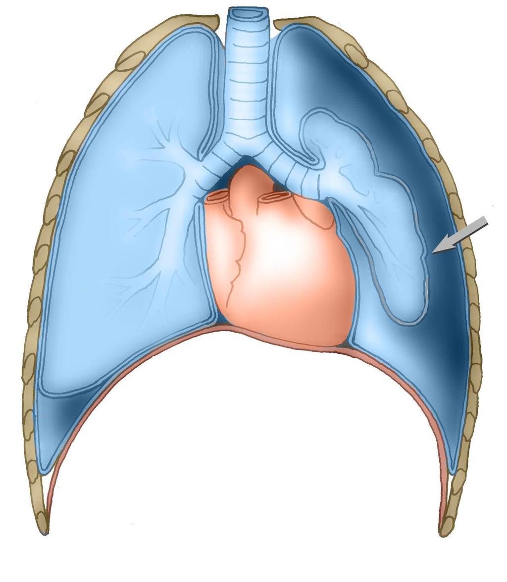 pleura parietalis pneumothorax ( zrušení podtlaku -