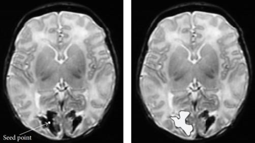 2), u metody segmentace narůstání oblastí jsou nejprve ručně vybrány počáteční body (semínka seeds).