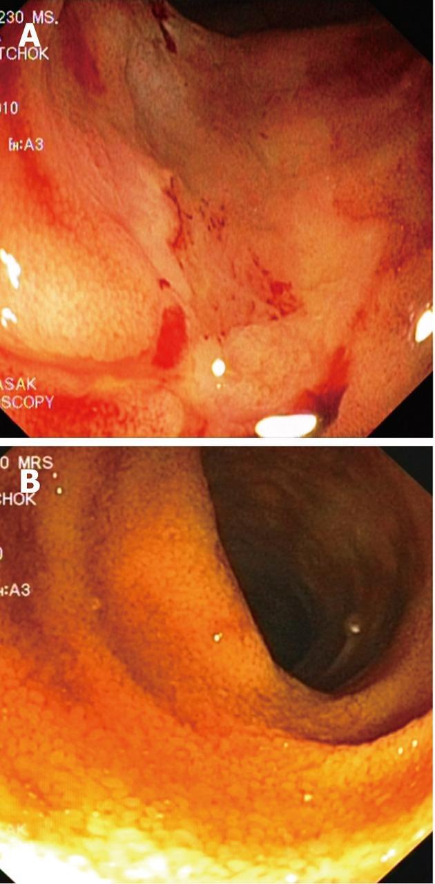 Akutní krvácení Crohnova choroba Infliximab stopped severe gastrointestinal